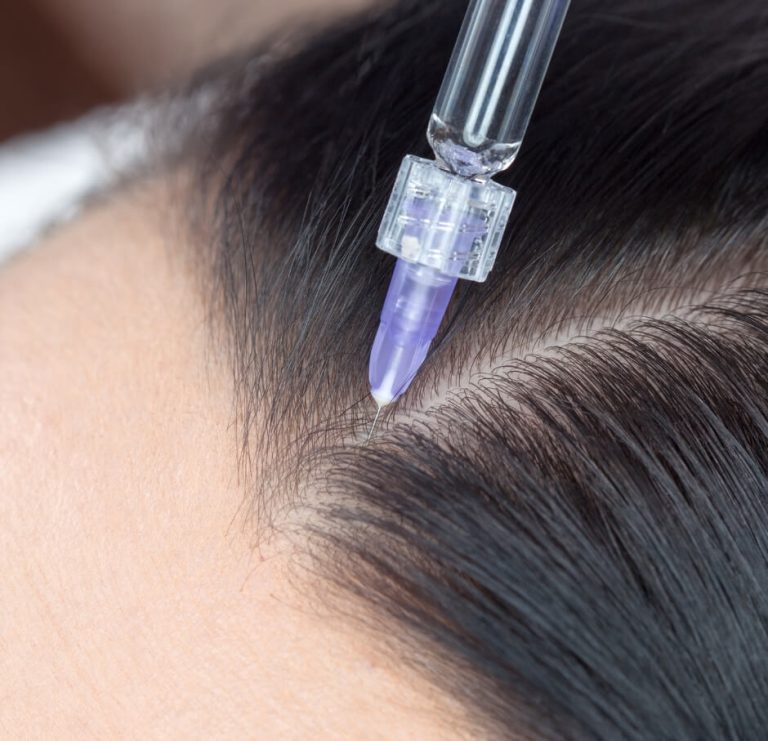 Mesotherapy for Hair Loss in Dubai